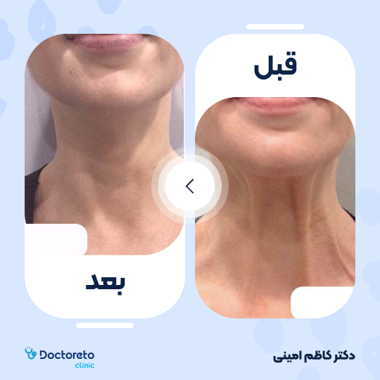 جوانسازی صورت با اگزوزوم تراپی و پلاسماتراپی (هر جلسه)