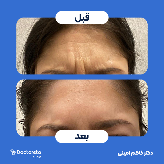 تزریق بوتاکس صورت (خط اخم) با برند مصپورت