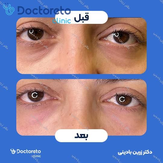 تزریق ژل زیر چشم با برند فیوریج (1cc)