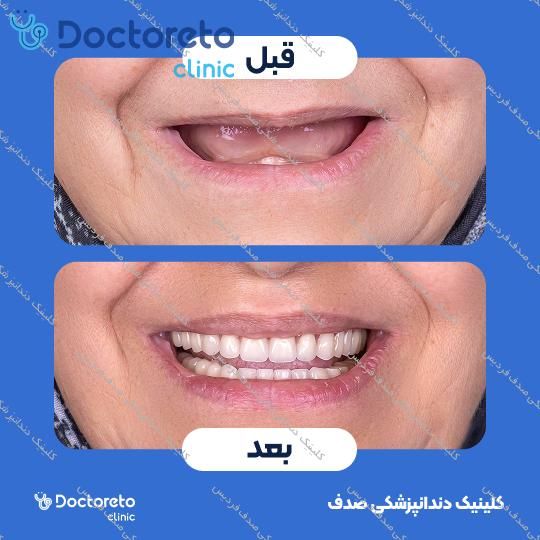 ایمپلنت core1 کره ای با روکش (هر واحد)