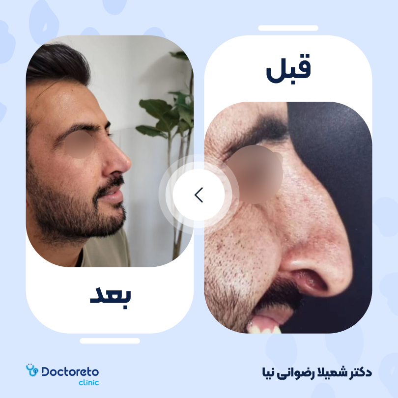 عمل جراحی بینی (رینوپلاستی)
