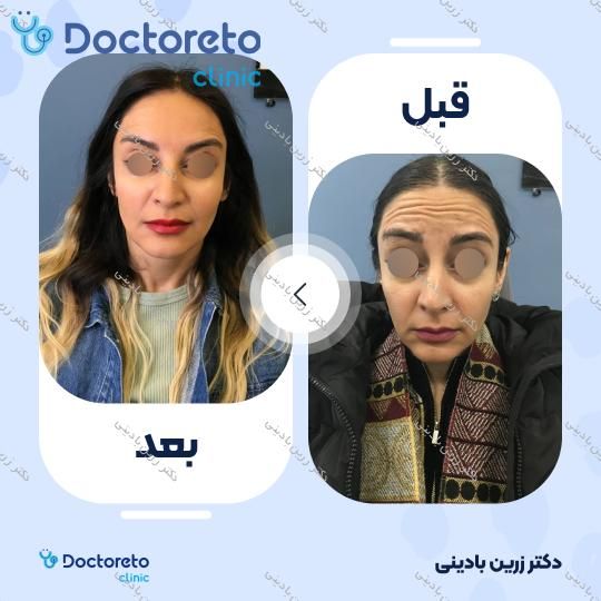 بوتاکس صورت (پیشانی، پنجه کلاغی، خط اخم) با برند دیستون