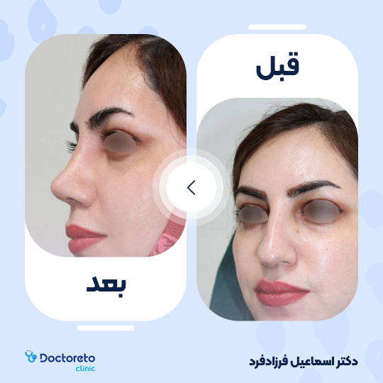 عمل زیبایی بینی (رینوپلاستی)