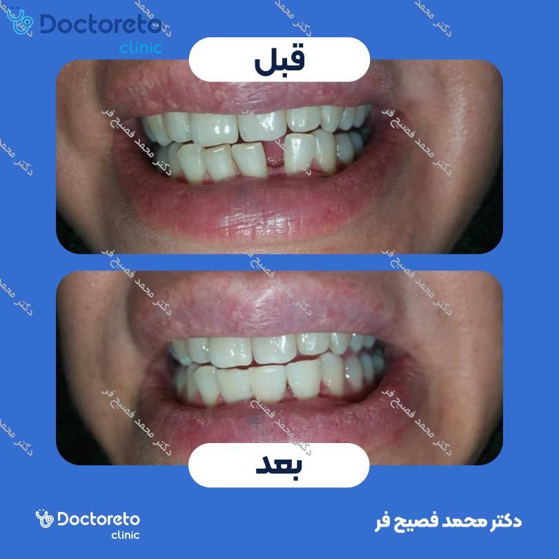 پرکردن دندان 3 سطحی با کامپوزیت