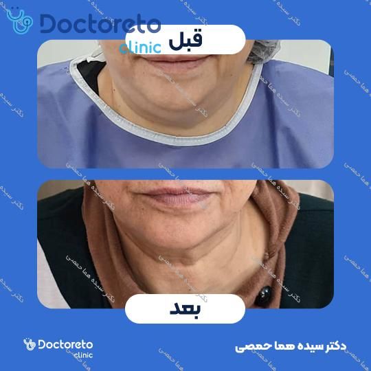 رفع غبغب به روش ساکشن