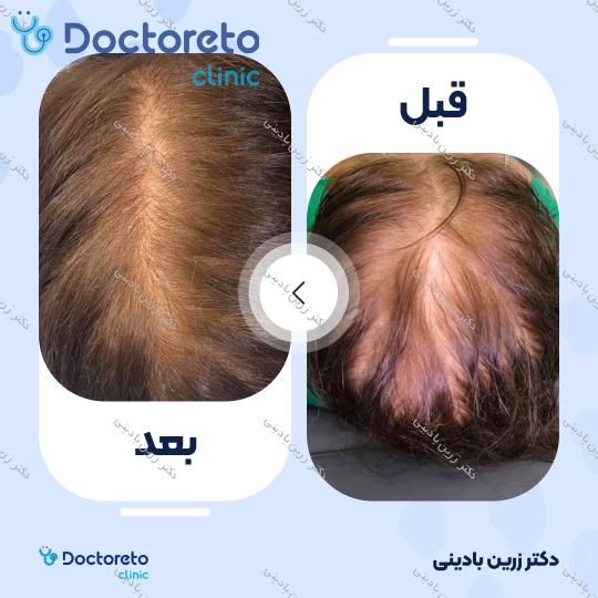 مزوتراپی مو سر با برند رویتا هیرکر فرانسه (هر جلسه)