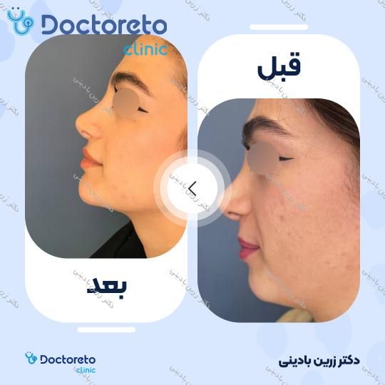 تزریق ژل چانه با برند فیوریج (1cc)