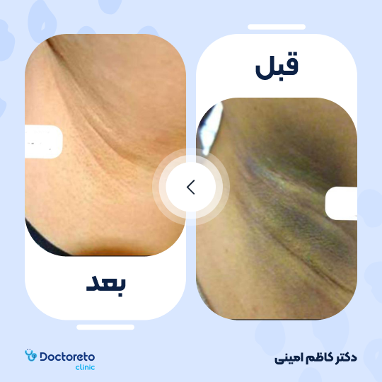 جوانسازی و رفع تیرگی پوست با کربوکسی تراپی (هر جلسه)