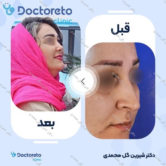 عمل جراحی مجدد زیبایی بینی (رینوپلاستی)