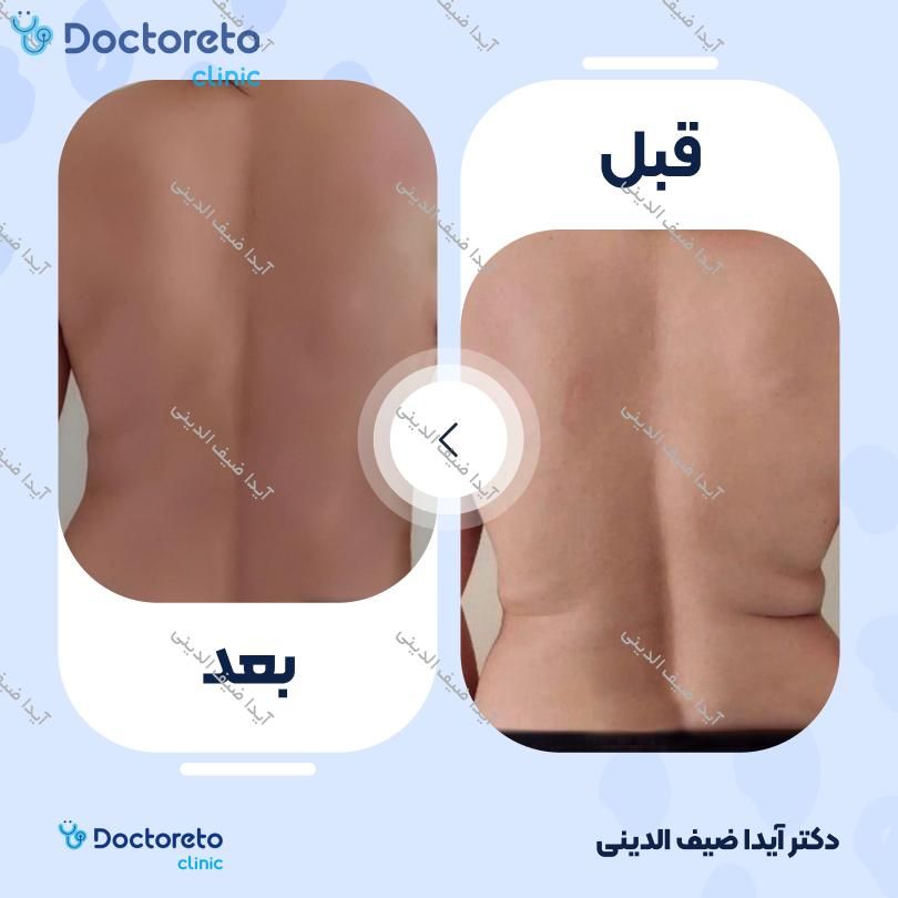 لاغری موضعی (شکم) با دستگاه کویتیشن (بانوان)(هرجلسه)