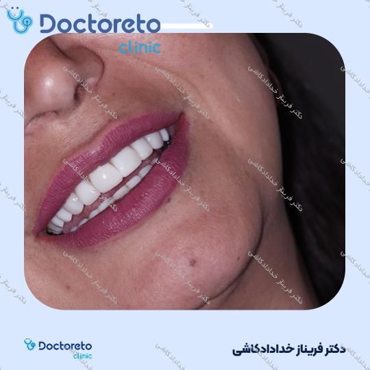 ونیر کامپوزیت لیرینگ (هر واحد)