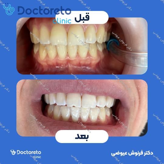 هوم بلیچینگ دو فک با ماده FGM آلمانی