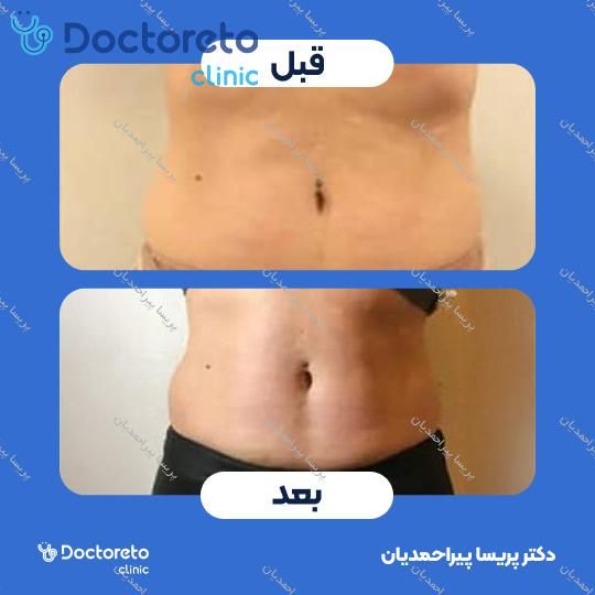 لاغری موضعی (شکم، پهلو، ران، بازو و خط پشت سینه) با دستگاه آر اف کویتیشن (10جلسه ، 60 دقیقه)
