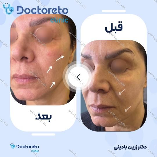 تزریق ژل گونه با برند فیوریج (1cc)