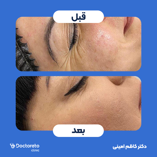 تزریق بوتاکس صورت ( خطوط پنجه کلاغی) با برند مصپورت