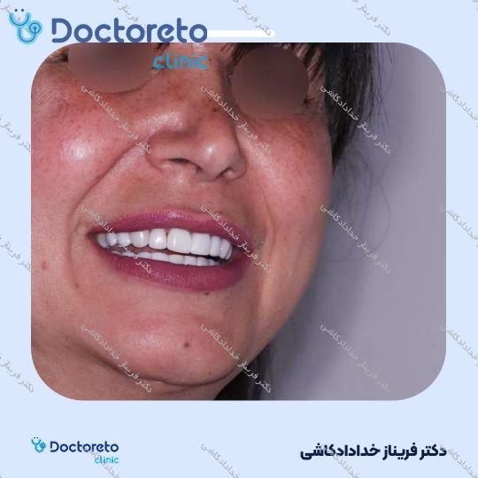 ونیر کامپوزیت سوئیسی (هر واحد)
