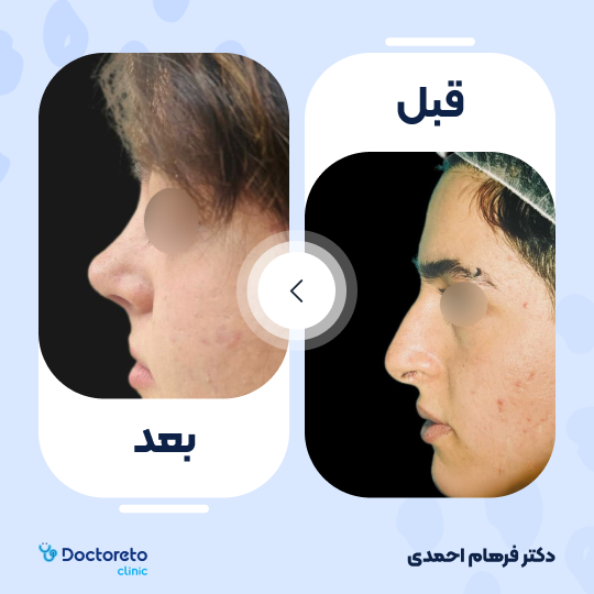 عمل جراحی مجدد زیبایی بینی (رینوپلاستی)