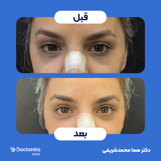 جوانسازی و روشن سازی سیاهی دور چشم با روش پلاسما تراپی