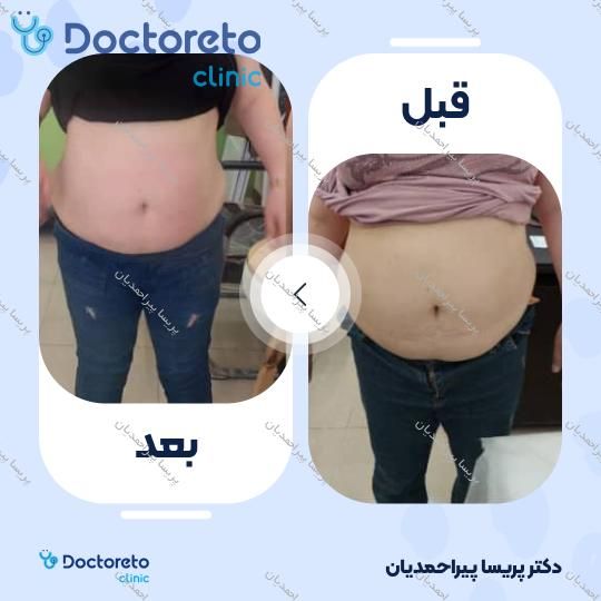 لاغری موضعی (شکم، پهلو، ران، بازو و خط پشت سینه) با دستگاه آر اف کویتیشن (هرجلسه ، 60 دقیقه)