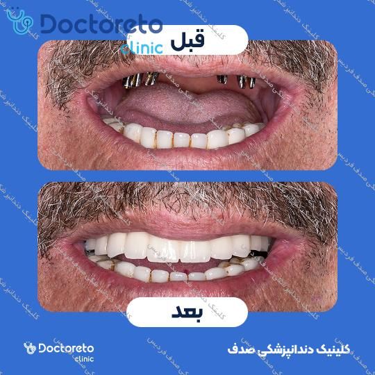 ایمپلنت core1 کره ای با روکش (هر واحد)