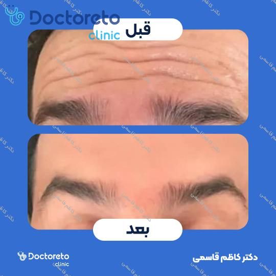 تزریق بوتاکس پیشانی با برند مصپورت