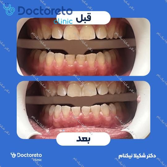 آفیس بلیچینگ هر فک با ماده آمریکایی