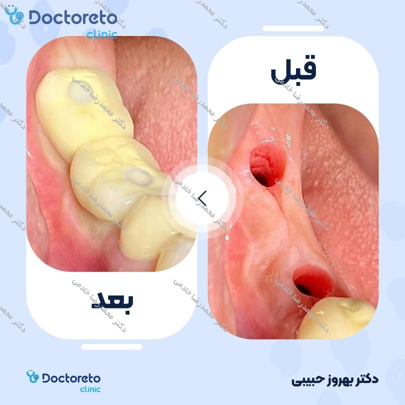 پرکردن دندان یک سطحی با آمالگام