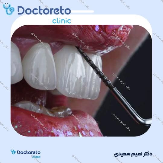 لمینت آی پی اس ایمکس (هر واحد)