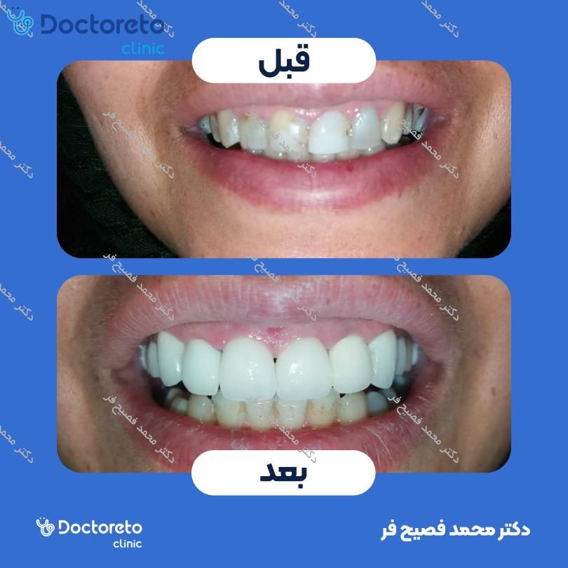 روکش تمام سرامیک زیرکونیا (هر واحد)