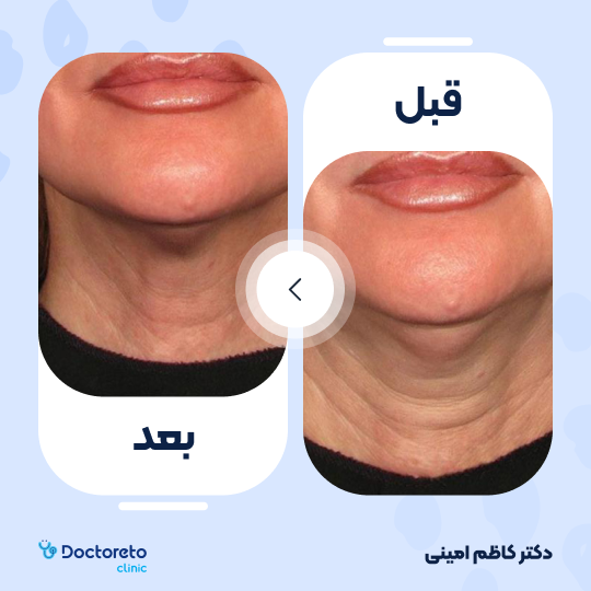 جوانسازی صورت با اگزوزوم تراپی و پلاسماتراپی (هر جلسه)