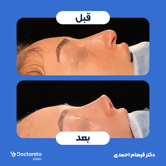 عمل جراحی مجدد زیبایی بینی (رینوپلاستی)