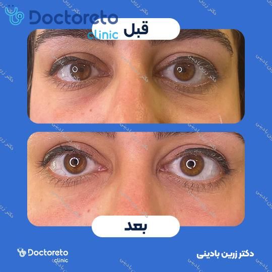 تزریق ژل زیر چشم با برند فیوریج (1cc)
