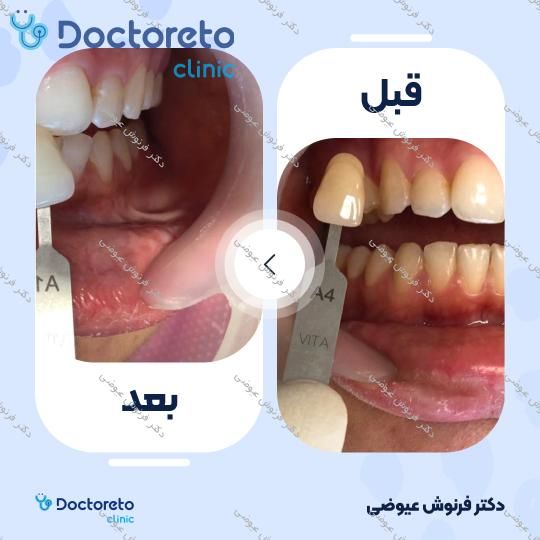 روکش دندان PFM (هر واحد)