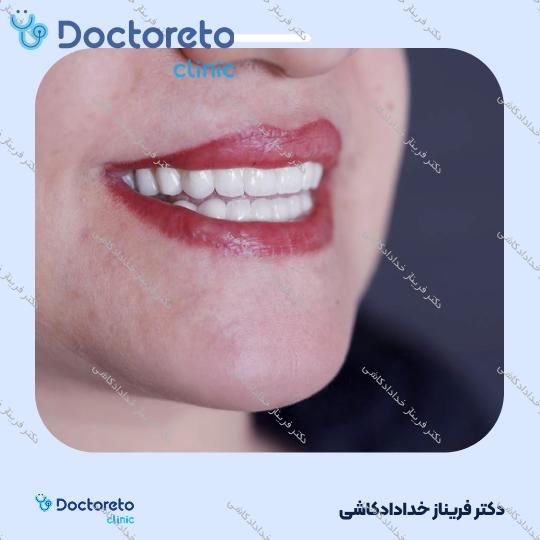 ونیر کامپوزیت سوئیسی (هر واحد)