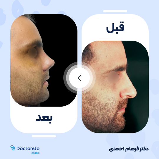 عمل زیبایی بینی (رینوپلاستی)