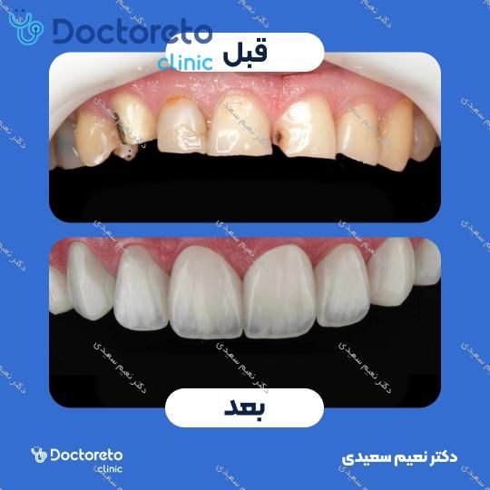 لمینت آی پی اس ایمکس (هر واحد)