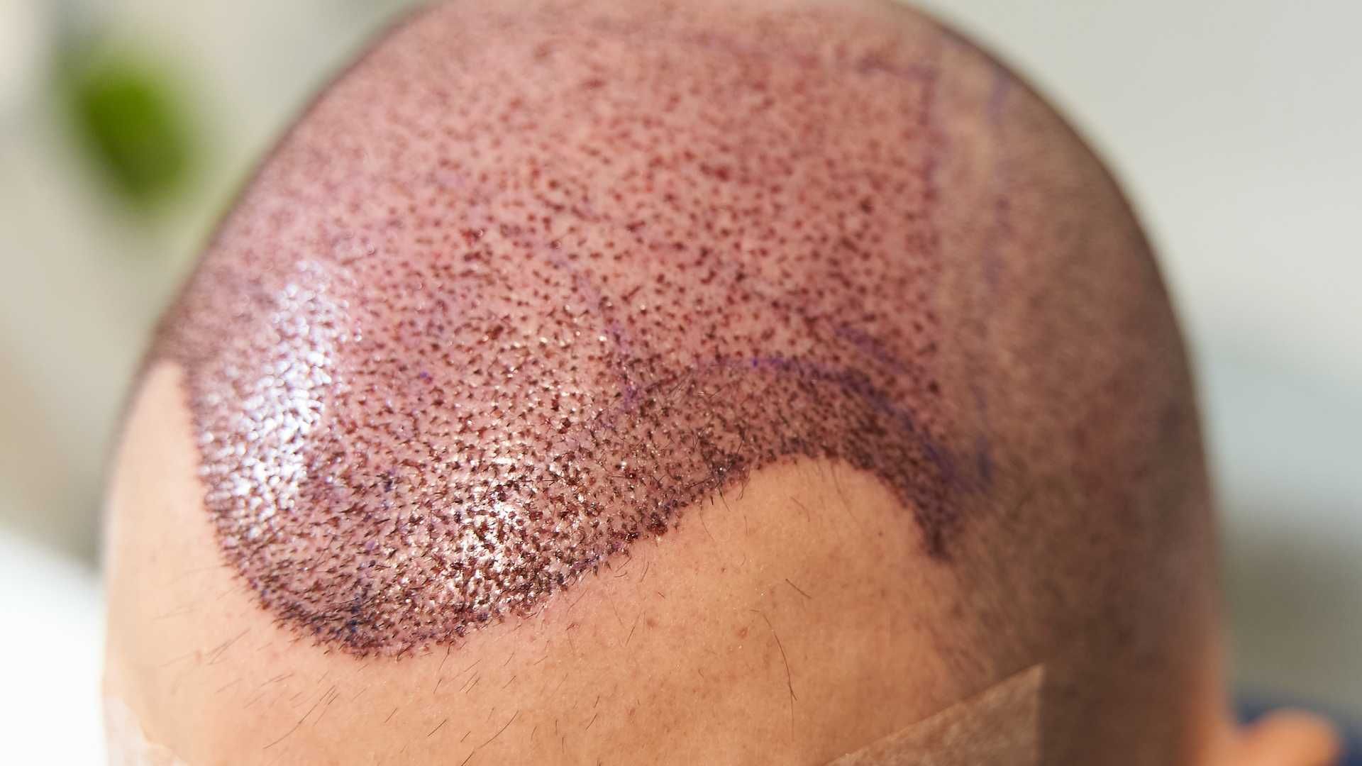 کاشت مو به روش FUT