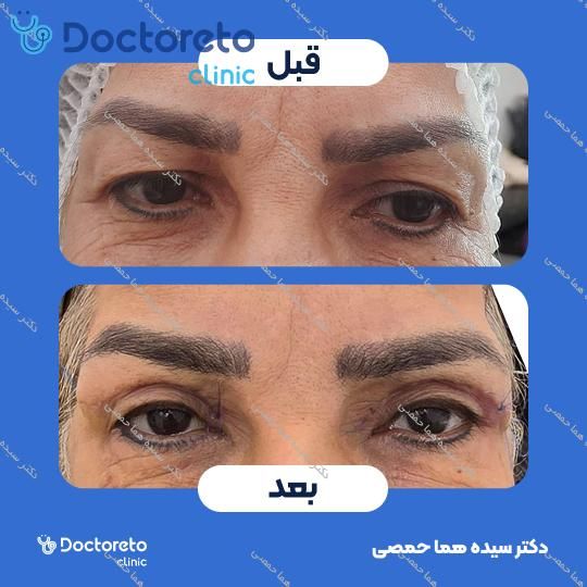 بلفاروپلاستی پلک بالا به روش جراحی