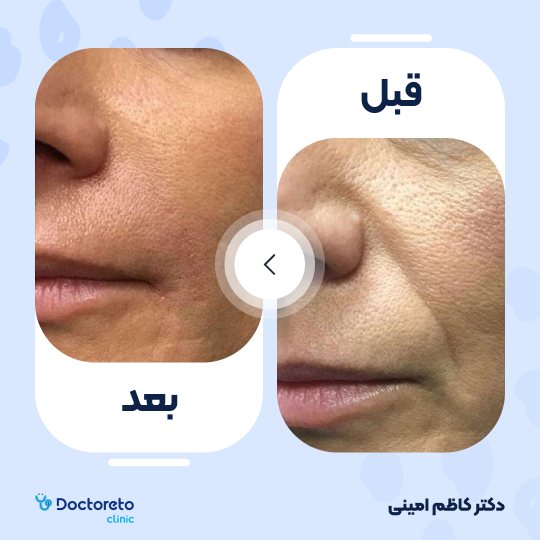 جوانسازی صورت با اگزوزوم تراپی و پلاسماتراپی (هر جلسه)