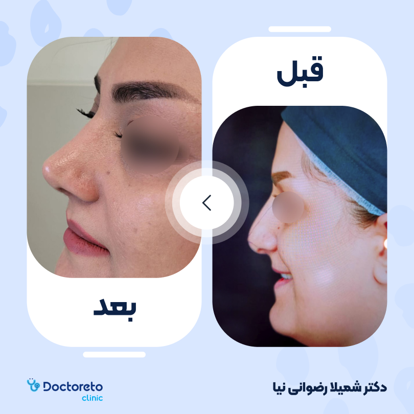 عمل جراحی مجدد زیبایی بینی (رینوپلاستی)