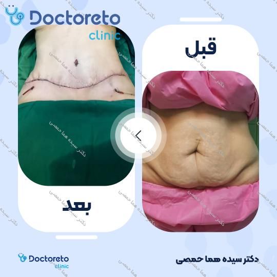 کاهش چربی بدن به روش لیپوساکشن