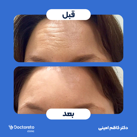 تزریق بوتاکس صورت (پیشانی) با برند مصپورت