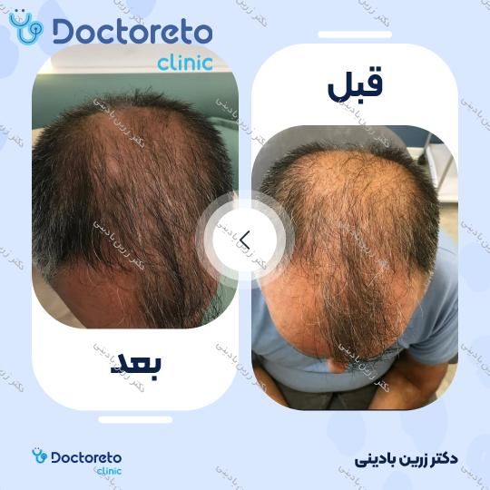 تزریق هیر فیلر مو جهت قطع ریزش مو با برند DR CYJ (هر جلسه )