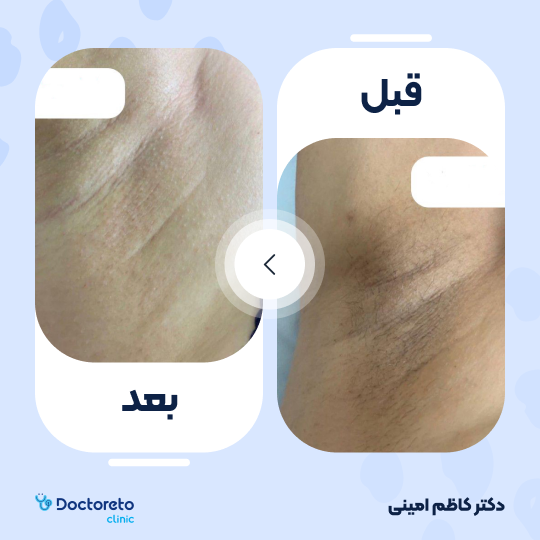 جوانسازی و رفع تیرگی پوست با کربوکسی تراپی (هر جلسه)