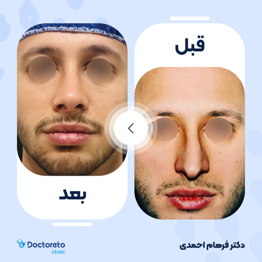 عمل زیبایی بینی (رینوپلاستی)