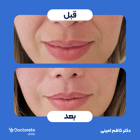 جوانسازی صورت با اگزوزوم تراپی و پلاسماتراپی (هر جلسه)