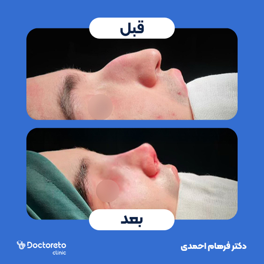 عمل جراحی مجدد زیبایی بینی (رینوپلاستی)