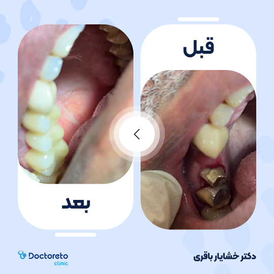 روکش دندان آنلی تمام سرامیکی ایمکس (هر واحد)