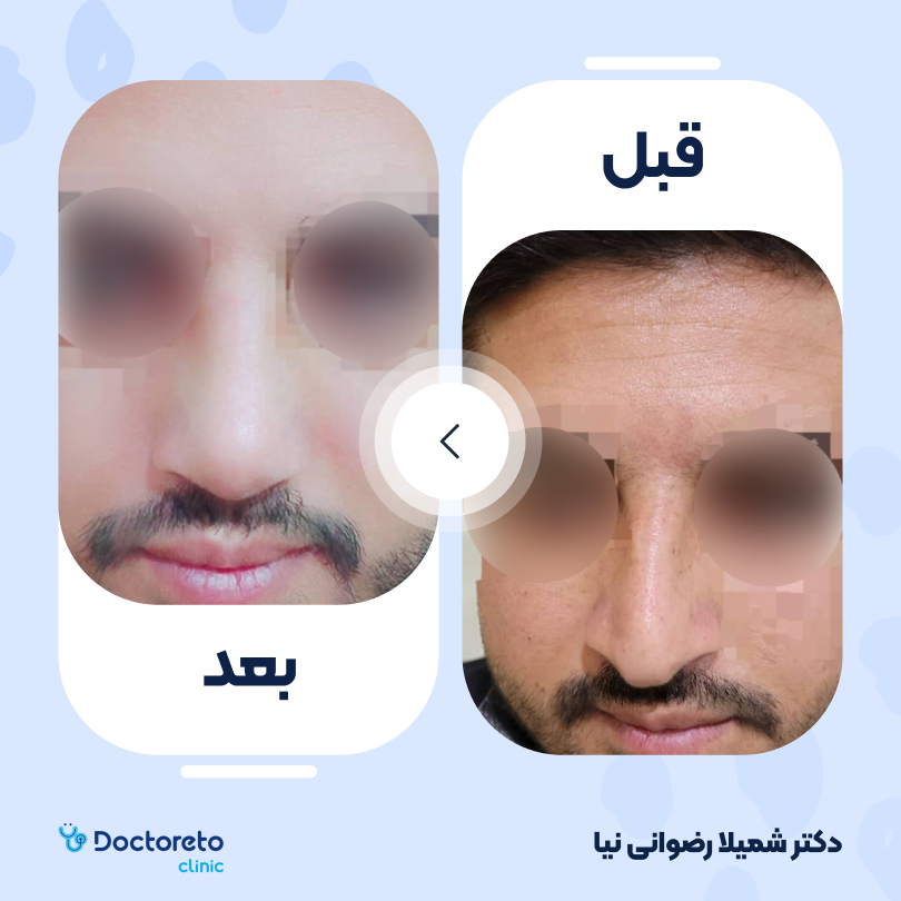 عمل زیبایی بینی گوشتی (رینوپلاستی) دکتر شمیلا رضوانی نیا در شیراز 4