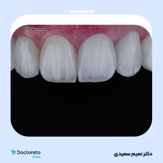 لمینت آی پی اس ایمکس (هر واحد)